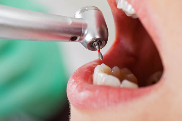 Best Emergency Wisdom Tooth Extraction in Broadview, IL